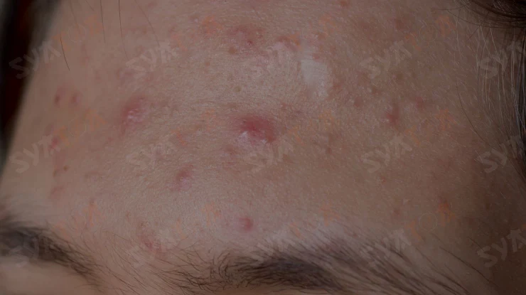 মুখে ব্রণ হলে কি মাখা উচিত acne 