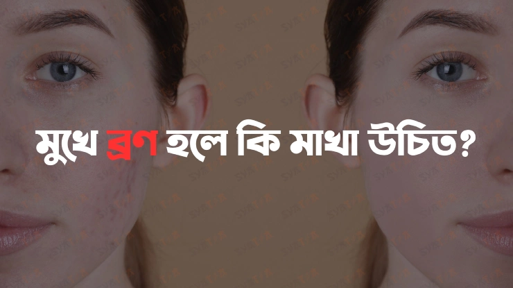 মুখে ব্রণ হলে কি মাখা উচিত acne